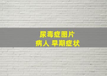 尿毒症图片 病人 早期症状